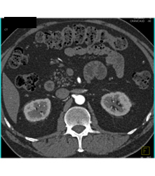 Carcinoma of the Uncinate Process - CTisus CT Scan