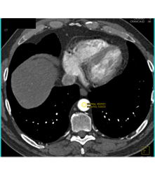 Example of User Bolus Triggering for Evaluation of the Pancreas With Dual Source CT - CTisus CT Scan