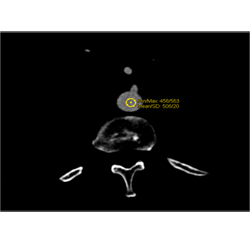 Example of User Bolus Triggering for Evaluation of the Pancreas With Dual Source CT - CTisus CT Scan