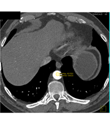 Example of User Bolus Triggering for Evaluation of the Pancreas With Dual Source CT - CTisus CT Scan