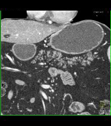 Multiple Intraductal Papillary Mucinous Neoplasms (IPMNs) - CTisus CT Scan