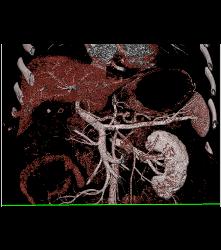 Multiple Intraductal Papillary Mucinous Neoplasms (IPMNs) - CTisus CT Scan