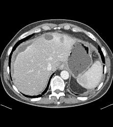 Pancreatic Cancer With Carcinomatosis. See Implants on Liver Surface - CTisus CT Scan