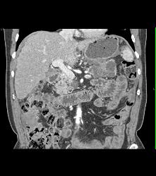 Pancreatic Cancer With Carcinomatosis. See Implants on Liver Surface - CTisus CT Scan