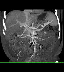 Pancreatic Cancer With Carcinomatosis. See Implants on Liver Surface - CTisus CT Scan