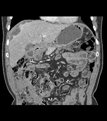 Pancreatic Cancer With Carcinomatosis. See Implants on Liver Surface - CTisus CT Scan