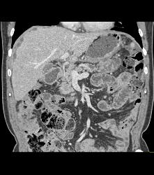 Pancreatic Cancer With Carcinomatosis. See Implants on Liver Surface - CTisus CT Scan