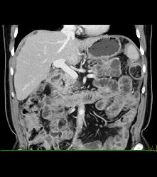 Pancreatic Cancer With Carcinomatosis. See Implants on Liver Surface - CTisus CT Scan