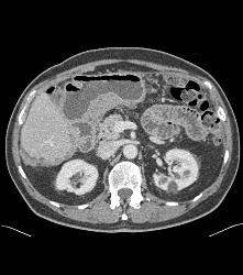 Pancreatic Cancer With Carcinomatosis. See Implants on Liver Surface - CTisus CT Scan