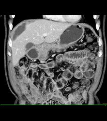 Pancreatic Cancer With Carcinomatosis. See Implants on Liver Surface - CTisus CT Scan