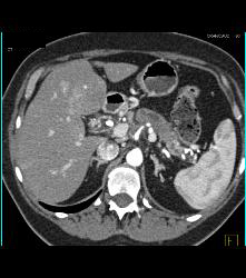 Pancreatic Cancer With Liver Metastases. Tumor Encases PV/SMV - CTisus CT Scan