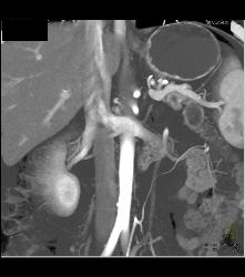 Pancreatic Cancer With Liver Metastases. Tumor Encases PV/SMV - CTisus CT Scan