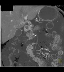 Pancreatic Cancer With Liver Metastases. Tumor Encases PV/SMV - CTisus CT Scan