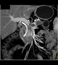 Pancreatic Cancer With Liver Metastases. Tumor Encases PV/SMV - CTisus CT Scan