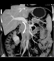 Pancreatic Cancer With Liver Metastases. Tumor Encases PV/SMV - CTisus CT Scan