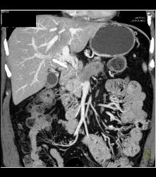 Pancreatic Cancer With Liver Metastases. Tumor Encases PV/SMV - CTisus CT Scan