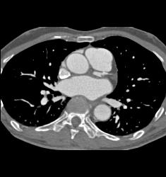 Incidental Pulmonary Embolism (PE) in Pancreatic Cancer Patient - CTisus CT Scan