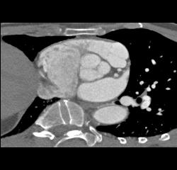 Incidental Pulmonary Embolism (PE) in Pancreatic Cancer Patient - CTisus CT Scan