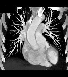 Incidental Pulmonary Embolism (PE) in Pancreatic Cancer Patient - CTisus CT Scan