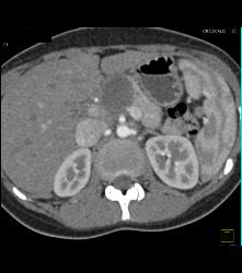 SPEN Tumor - CTisus CT Scan