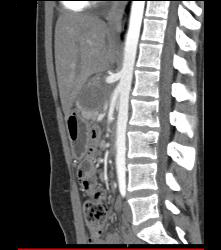 SPEN Tumor - CTisus CT Scan