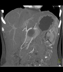 SPEN Tumor - CTisus CT Scan