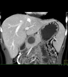 SPEN Tumor - CTisus CT Scan