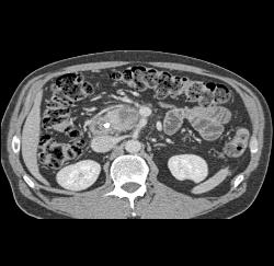 Adenocarcinoma of the Pancreas - CTisus CT Scan