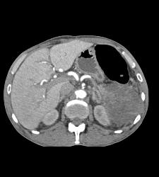 Perisplenic Bleed and Chronic Pancreatitis - CTisus CT Scan