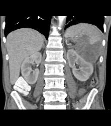 Perisplenic Bleed and Chronic Pancreatitis - CTisus CT Scan