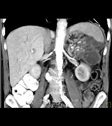 Perisplenic Bleed and Chronic Pancreatitis - CTisus CT Scan