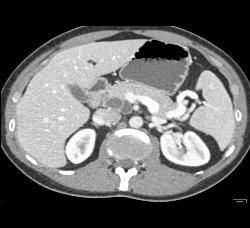 Intraductal Papillary Mucinous Neoplasm (IPMN) - CTisus CT Scan