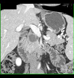 Intraductal Papillary Mucinous Neoplasm (IPMN) - CTisus CT Scan