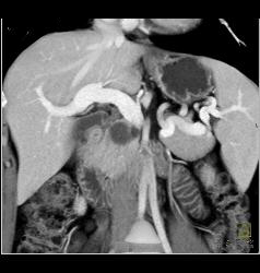 Intraductal Papillary Mucinous Neoplasm (IPMN) - CTisus CT Scan