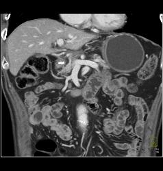 Post Whipple Procedure - CTisus CT Scan