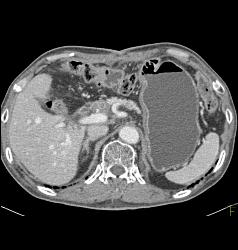 Post Whipple Procedure - CTisus CT Scan