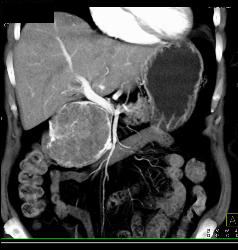 Serous Cystadenoma - CTisus CT Scan