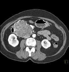 Serous Cystadenoma - CTisus CT Scan