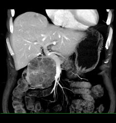 Serous Cystadenoma - CTisus CT Scan