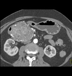 Serous Cystadenoma - CTisus CT Scan