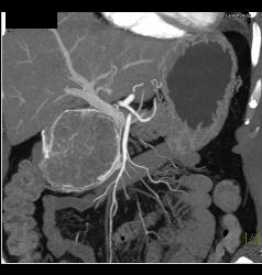 Serous Cystadenoma - CTisus CT Scan