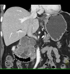 Serous Cystadenoma - CTisus CT Scan