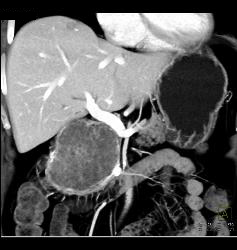 Serous Cystadenoma - CTisus CT Scan