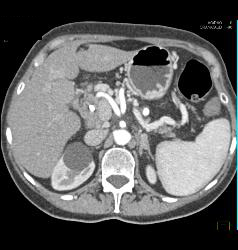 Pancreatic Cancer Encases PV/SMV - CTisus CT Scan