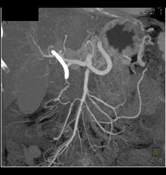 Pancreatic Cancer Encases PV/SMV - CTisus CT Scan