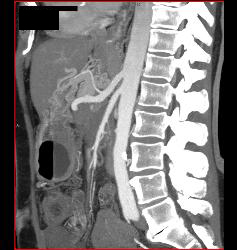 Pancreatic Cancer Encases PV/SMV - CTisus CT Scan