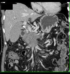 Pancreatic Cancer Encases PV/SMV - CTisus CT Scan