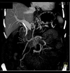 Pancreatic Cancer Encases PV/SMV - CTisus CT Scan