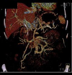 Pancreatic Cancer Encases PV/SMV - CTisus CT Scan