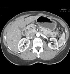 Subtle Islet Cell on Delayed Phase - CTisus CT Scan